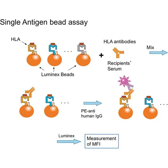 Anti HLA DSA (Donor Specific Antibody)